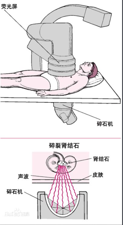 体外冲击波碎石3d演示,体外冲击波碎石对肾有多大危害