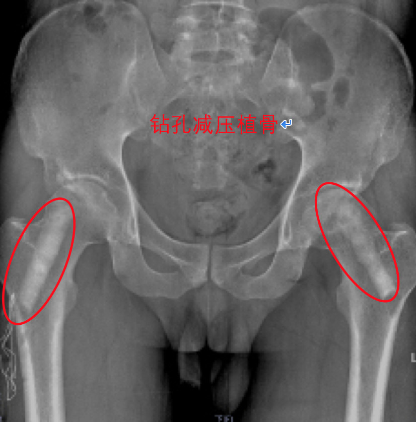 得了股骨头坏死又没钱治怎么办,股骨头坏死无药可治