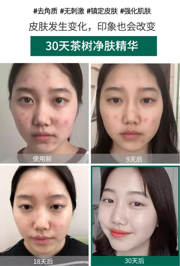 somebymi茶树精华测评,somebymi茶树精华能淡疤吗