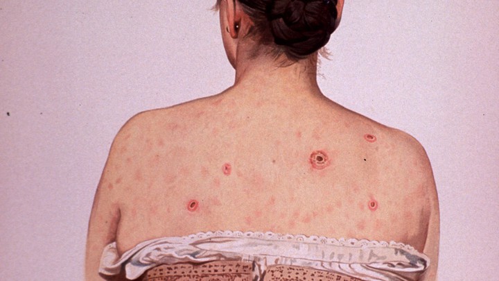 梅毒这个病是怎么形成的,梅毒是怎么出现在人类身上