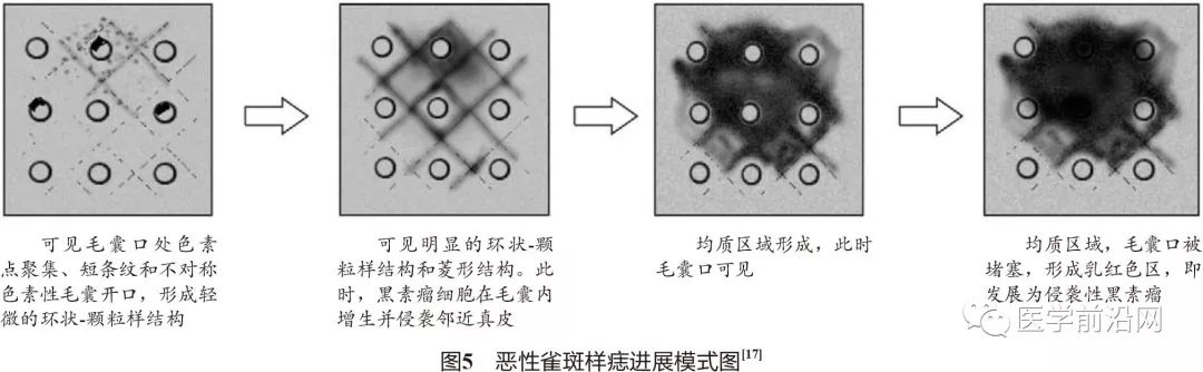 面部常见皮肤病皮肤镜诊断专家共识全文发布