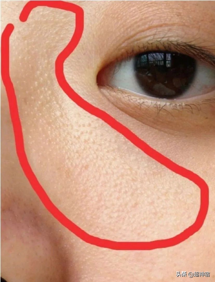 比痘痘更烦人的闭口来了，最有效的去闭口*法大**看过来