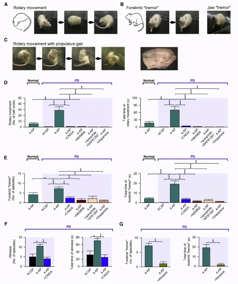 帕金森患者典型的震颤,帕金森病震颤的神经环路机制