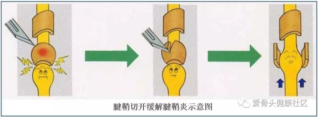 脚腱鞘炎一招搞定,腱鞘炎三个步骤轻松搞定