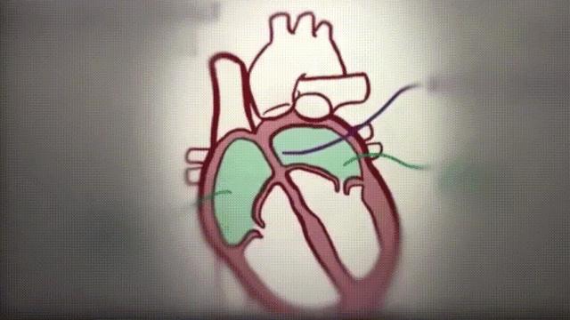 先天性心脏病手术协和医院免费,不用开胸的心脏手术