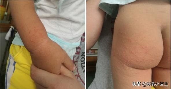 手足口病容易和哪些病混淆,儿科医生手足口病