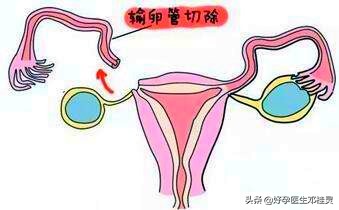 宫外孕保守治疗后成功怀孕案例,宫外孕3个月后再次宫外孕怎么办