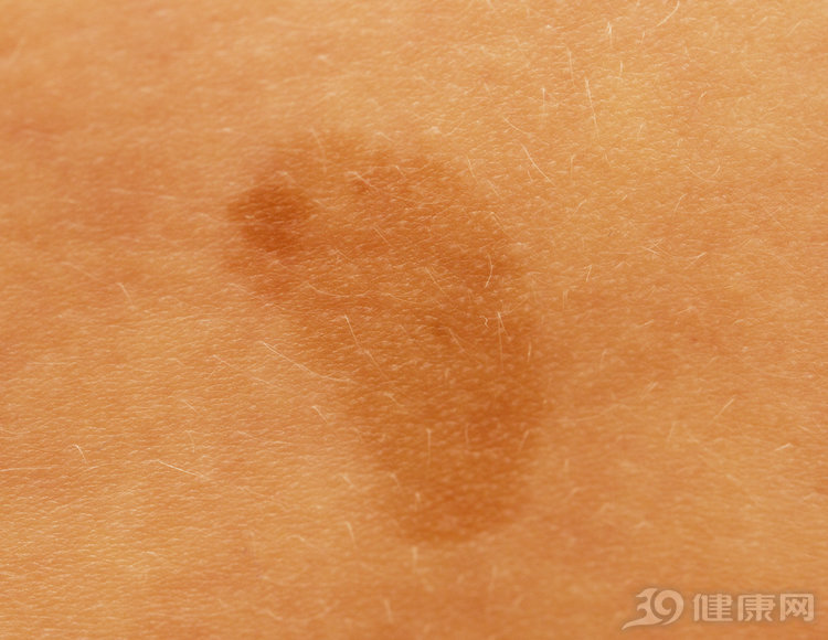 身上长牛奶咖啡斑，可能是神经纤维瘤，4招教你辨别良恶性