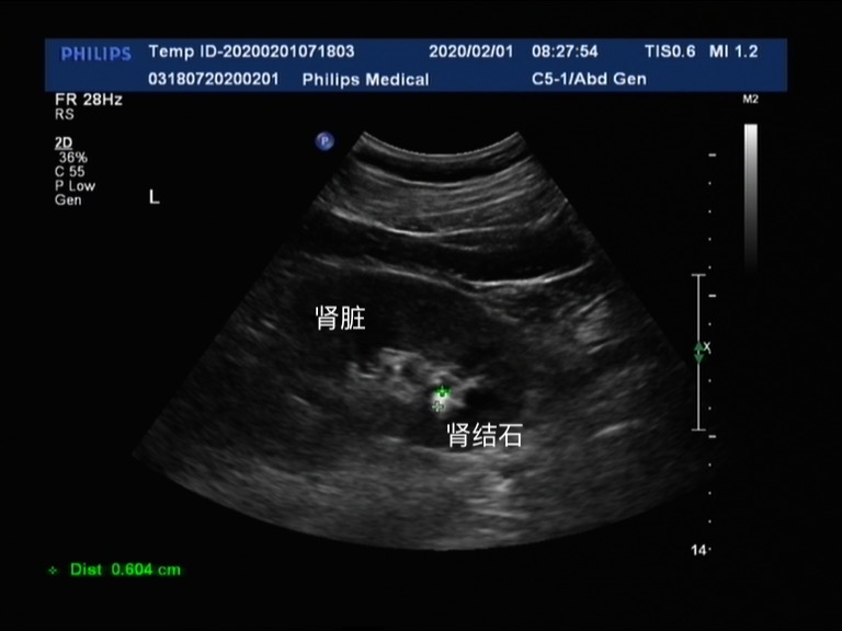 体检时说左肾有结石,医院怎样治疗肾结石好