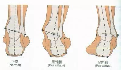 中风足内翻矫正方法视频,中风足内翻最有效的锻炼方法