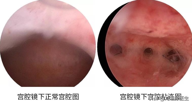 宫腔粘连合并妊娠,宫腔粘连容易导致生化妊娠吗