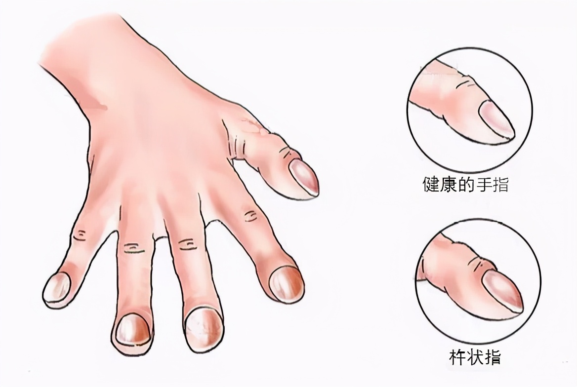 手上有三个有代表什么,中医看手掌怎么看出肺有问题