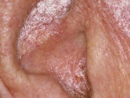 耳朵穿孔流脓能一直用抗生素吗,中耳炎辟谣