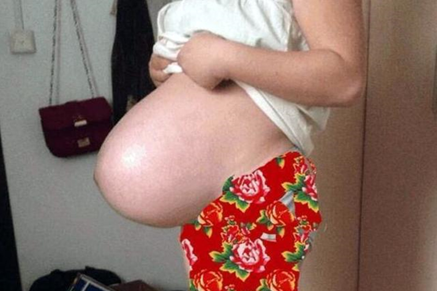 “悬浮肚”大多剖腹产,若想顺产需要先突破两大难题,为母不易