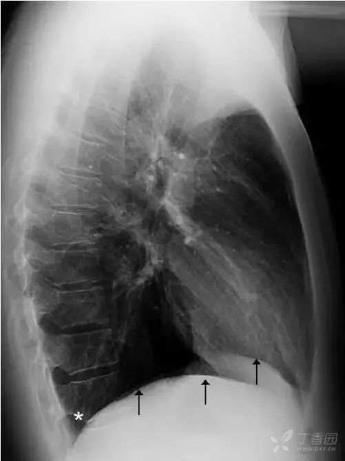 正常胸片图片,正常的胸片讲解
