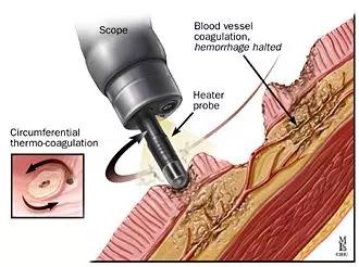 消化道出血的内镜治疗,消化道出血的内镜下治疗