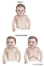 儿童支原体感染的原因,小孩支原体感染会传染家长吗