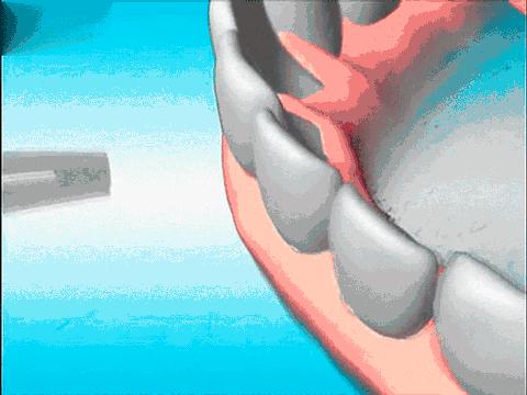 牙结石不洗牙用什么方法清除,牙结石有没有好的方法去除