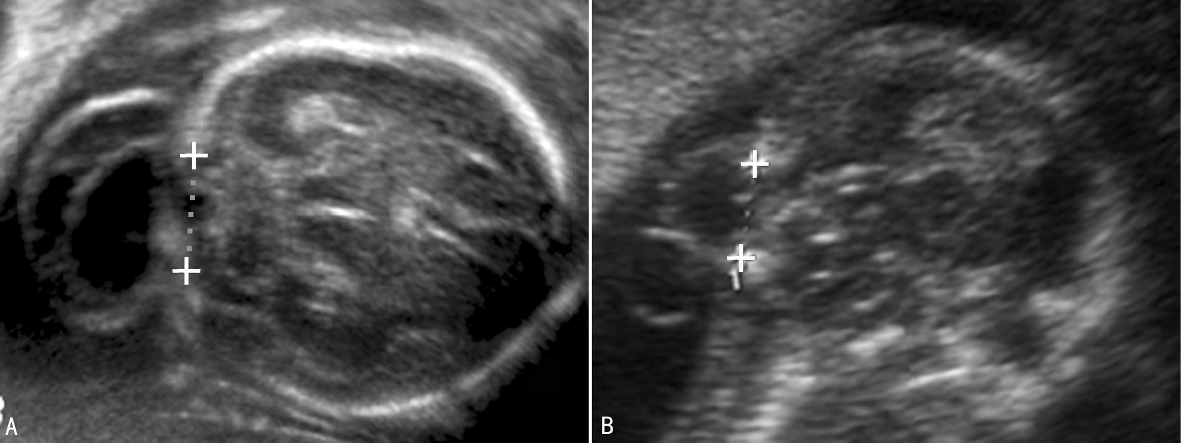 做普通彩超能不能看到胎儿侧脑室,超声胎儿针对性结构检查