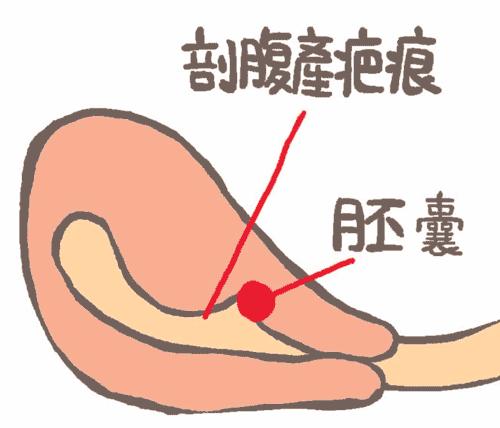 明明怀孕为什么宫内没有孕囊,明明有宫缩为什么医生说没有