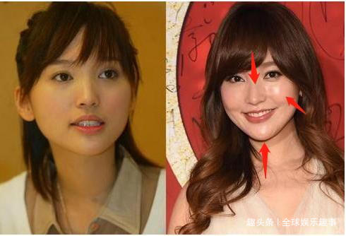 金莎打瘦脸针真实图片,金莎晒美照遭质疑整容没恢复好