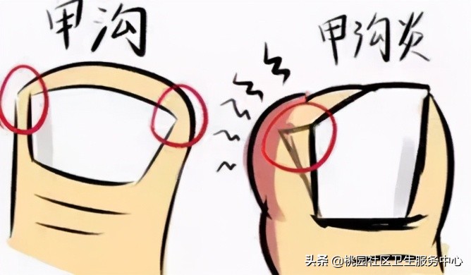 甲沟炎健康之路,健康科普甲沟炎