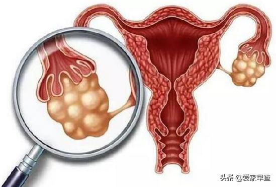 哪些女性易被卵巢癌“盯上”？如何防护？