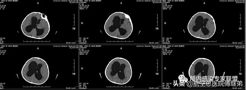 婴儿脑积水治疗方法动画演示,ommaya囊植入术是大手术吗
