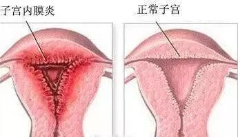 怎样的子宫内膜适合怀孕？吃柚子能长内膜？