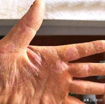 手部季节性脱皮有哪几种,手部脱皮严重是什么样的