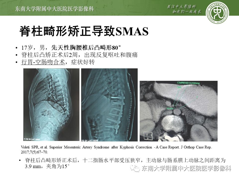 肠系膜上动脉压迫综合征挂什么科,肠系膜上动脉压迫综合征手术费用