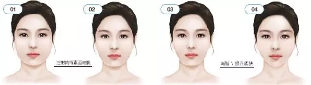 怎么才知道自己适不适合打瘦脸针,什么脸型不建议打瘦脸针