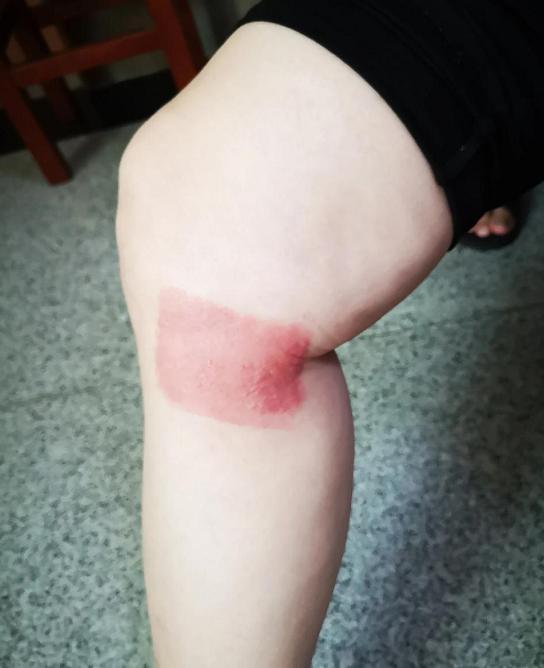 膝盖有骨刺和关节炎怎么治疗最好,膝关节长骨刺一冷就疼怎么治疗