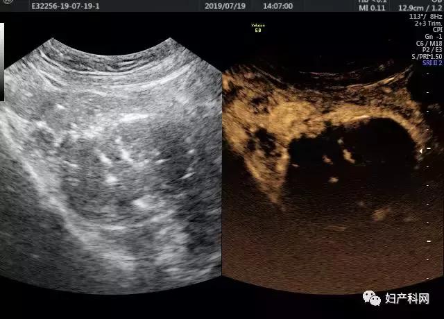 超声介入消融治疗卵巢囊肿,微无创治疗子宫肌瘤过程