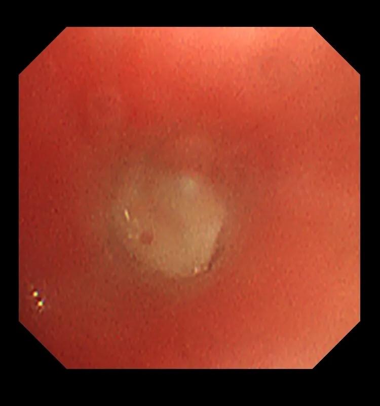 肺炎治不好会怎么样,肺炎治不好怎么办