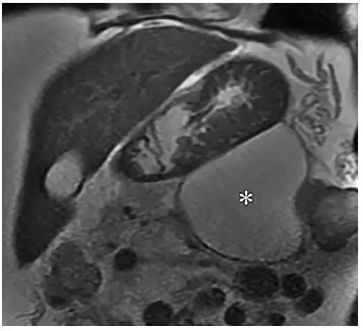 急性胰腺炎影像检查首选,急性坏死胰腺炎影像