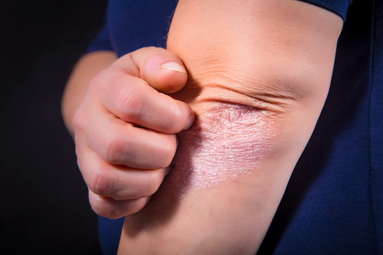 银屑病患者的健康宣教,银屑病患者的人生