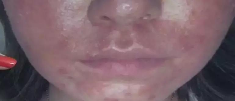 威海医院美容科祛斑,威海环翠区美容祛斑