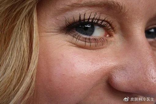 治痘用异维a酸软胶囊有效果吗,异维a酸软胶囊吃多久才不会长痘