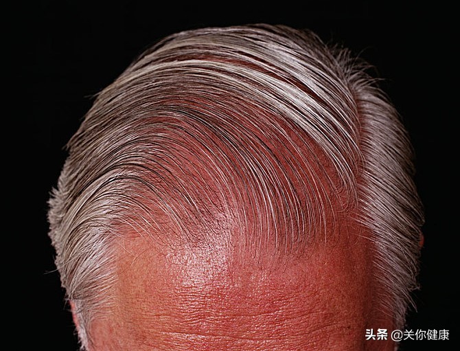 毛囊移植技术能够完全治愈脱发吗,脱发严重毛囊多长时间能自己恢复