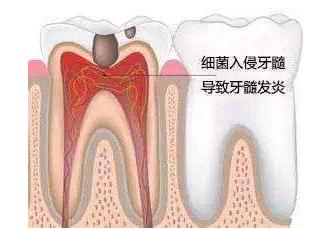 牙齿凌晨4.5点痛白天就不痛,牙齿白天不疼晚上疼是牙坏了吗