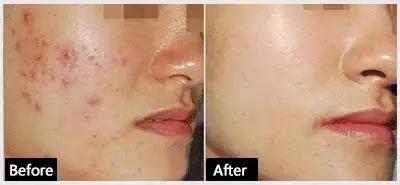 果酸可以根治闭口吗,果酸去闭口可以天天用吗