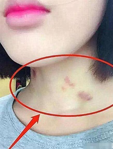 13岁女生脖子被种“草莓”，妈妈再三追问，孩子的回答让妈妈落泪