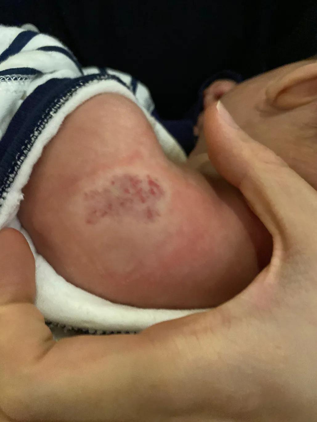 宝宝血管瘤用眼药水以后1个月淡化好多（带图）