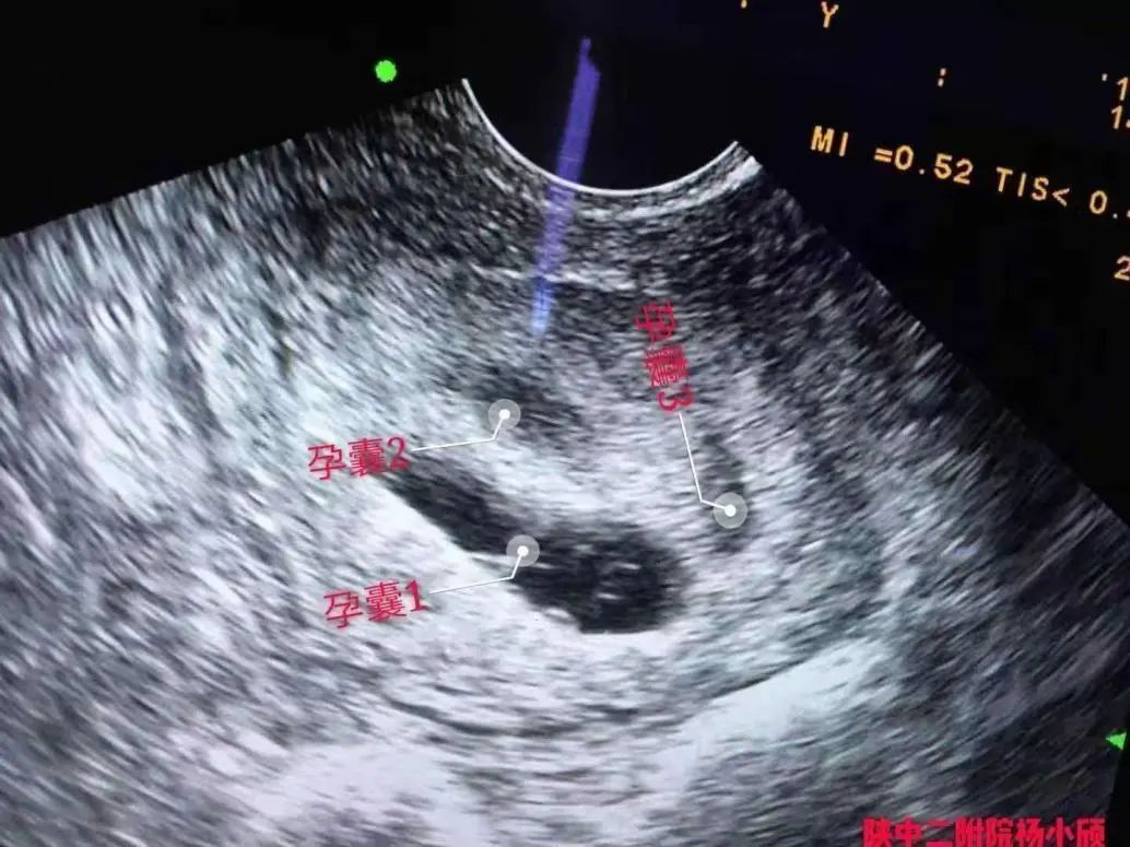 陕西中医药大学第二附属医院生殖内分泌科完成一例高难度减胎术