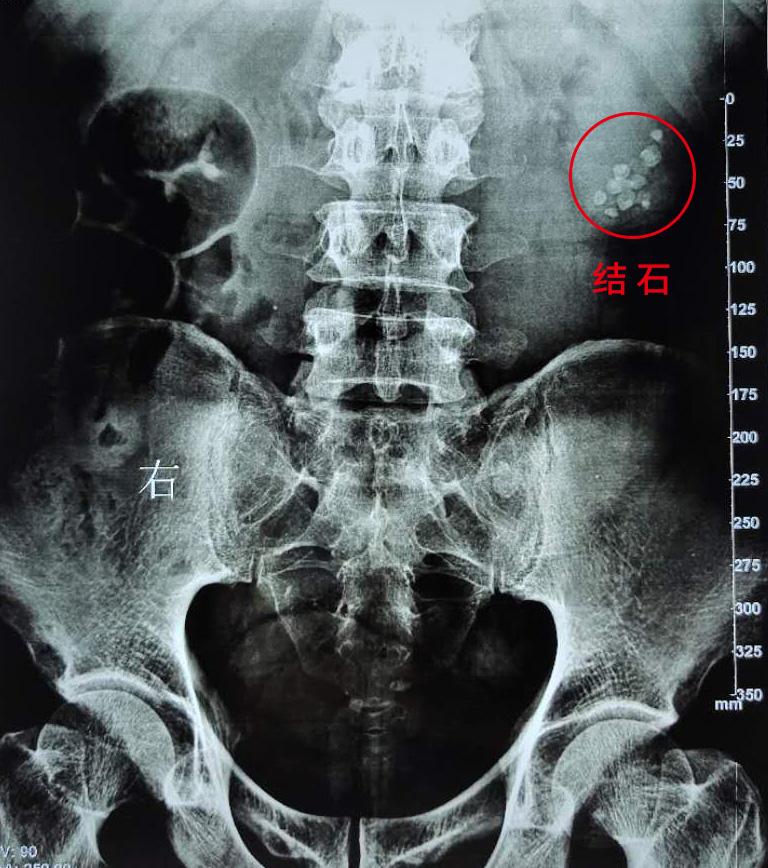 结石体质的人饮食应该注意些什么,结石体质是酸性体质还是碱性体质