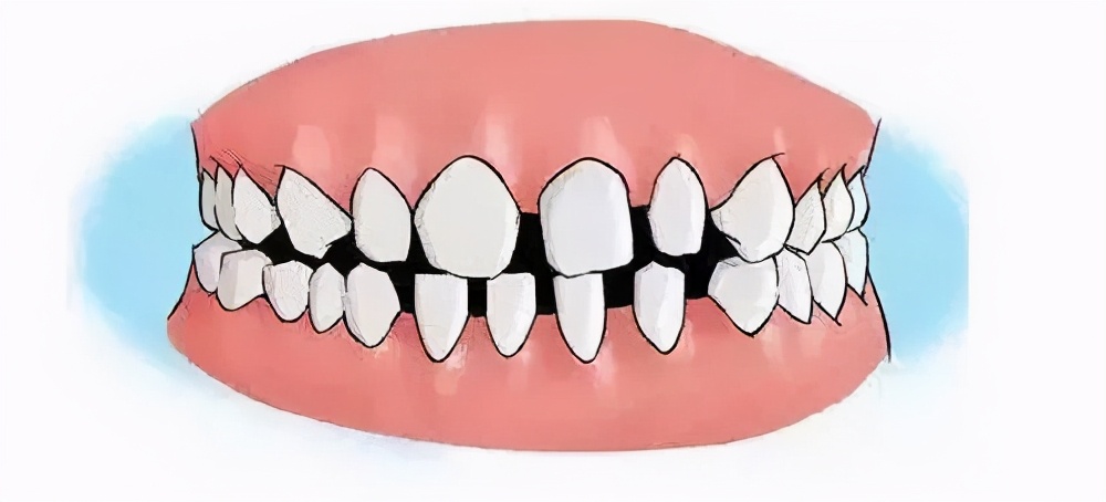 牙齿断裂有什么预兆,牙齿断裂伤到牙髓会怎么样