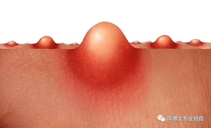 红蓝光祛痘对比图,库博士祛痘效果怎么样