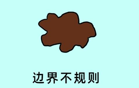 科普一颗平淡无奇的痣竟然会癌变,痣癌变的信号有哪些