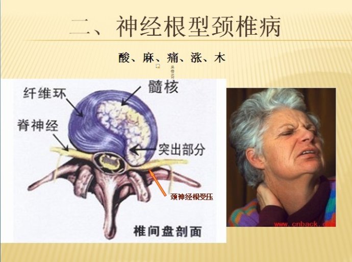 神经根型颈椎病保守治疗效果好吗,神经根型颈椎病保守治疗效果